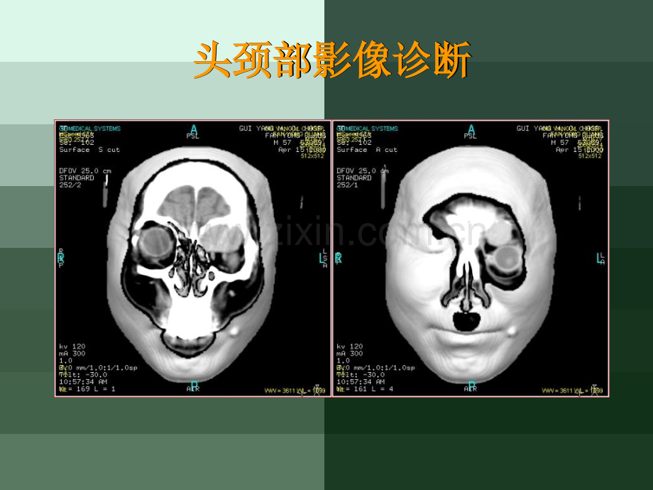 眶部影像.pptx_第1页