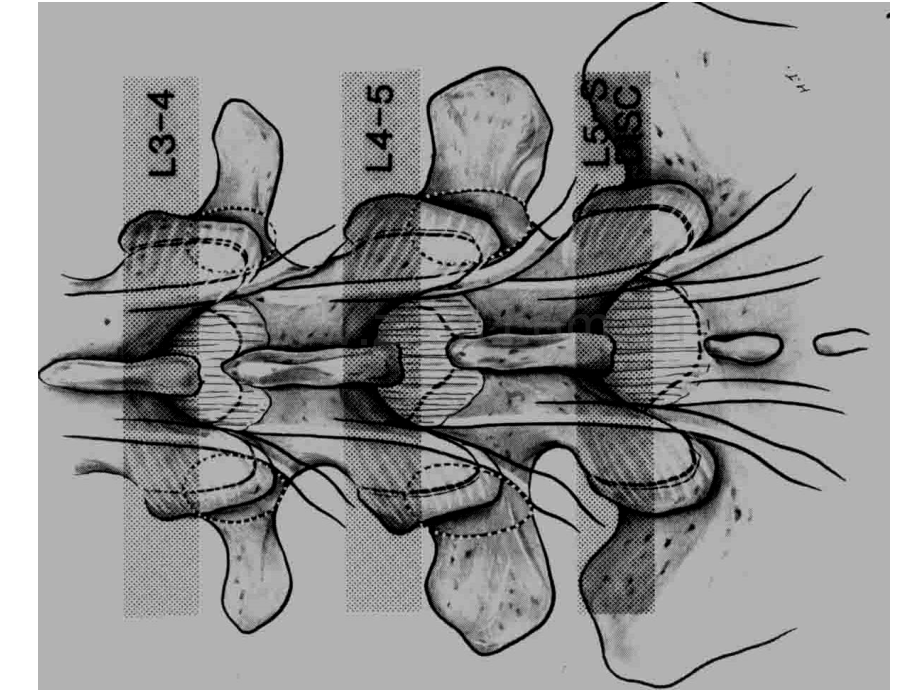 腰椎间盘突出症手术图解补充文字.pptx_第2页