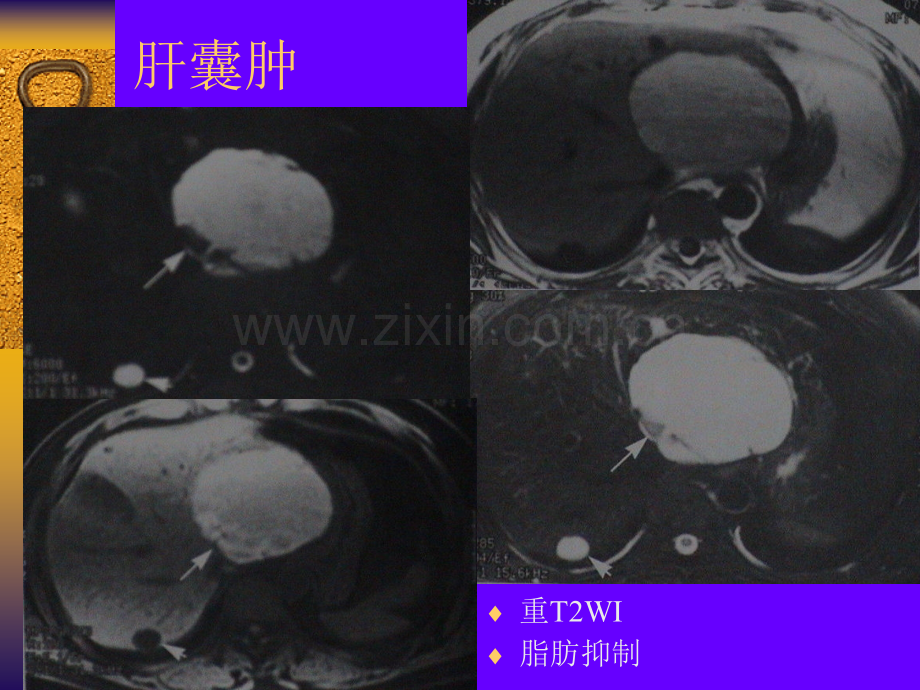 腹部疾病的MR诊断.pptx_第3页