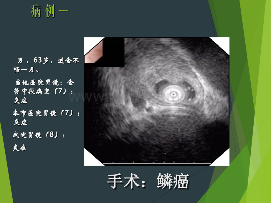 消化道黏膜隆起性病变的超声内镜诊断.pptx_第2页