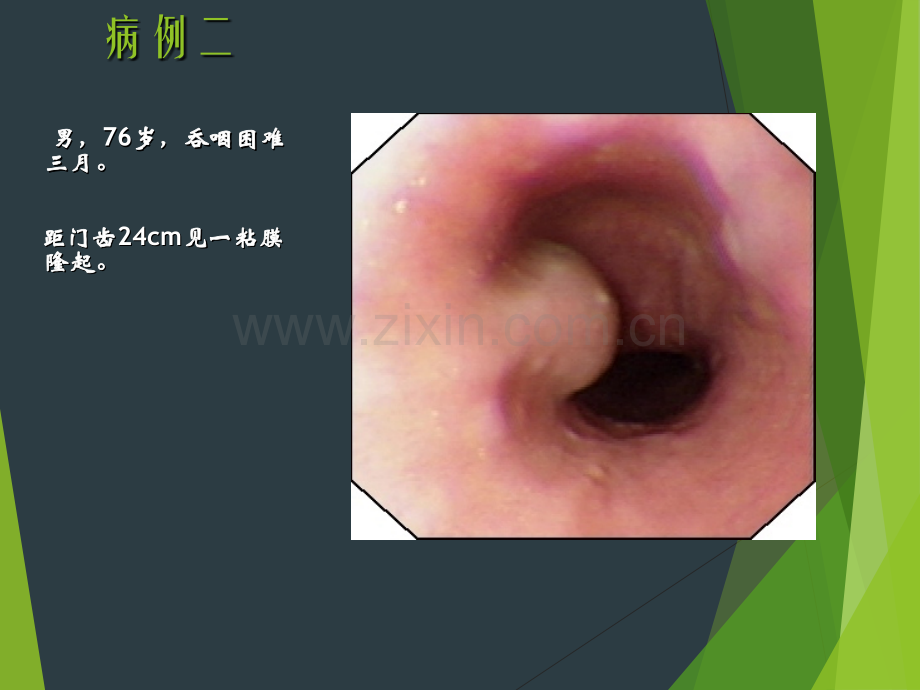 消化道黏膜隆起性病变的超声内镜诊断.pptx_第3页