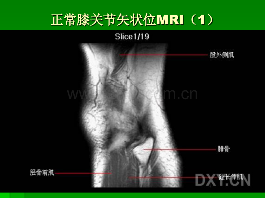 膝关节MRI解剖.pptx_第1页