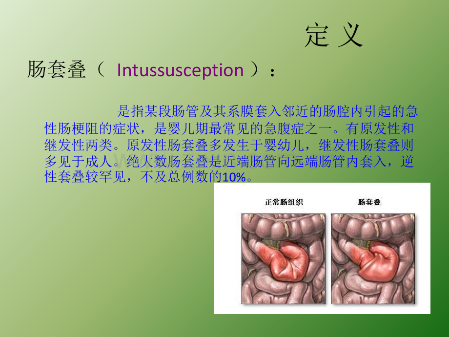 小儿肠套叠课件ppt课件.ppt_第3页