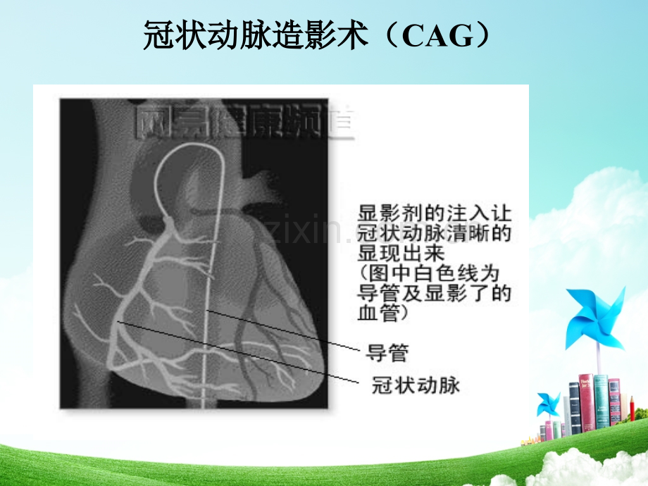 冠状动脉介入治疗术前及术后的护理.pptx_第3页