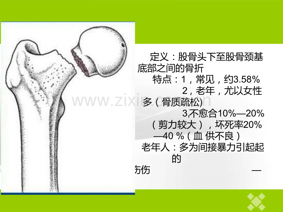 加压空心螺纹钉治疗股骨颈骨折.pptx_第2页