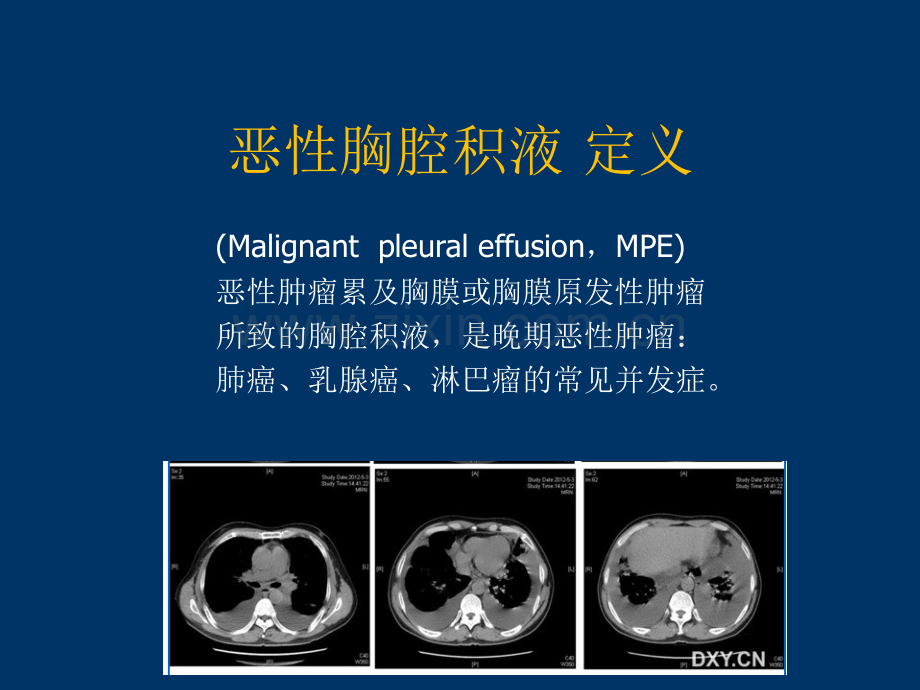 恶性浆膜腔积液概述.pptx_第3页