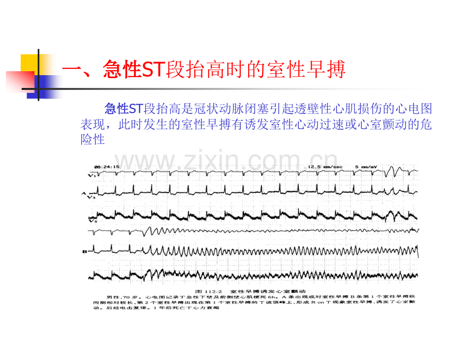 室性早搏与猝死0508.pptx_第2页