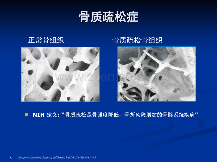 原发性骨质疏松症诊治指南.pptx_第2页