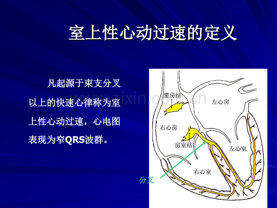 室上性心动过速鉴别诊断.pptx_第1页