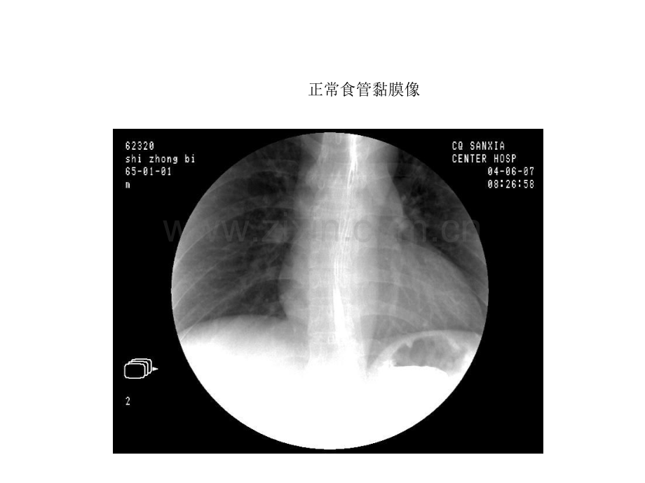 影像全套消化道钡餐图片.pptx_第1页