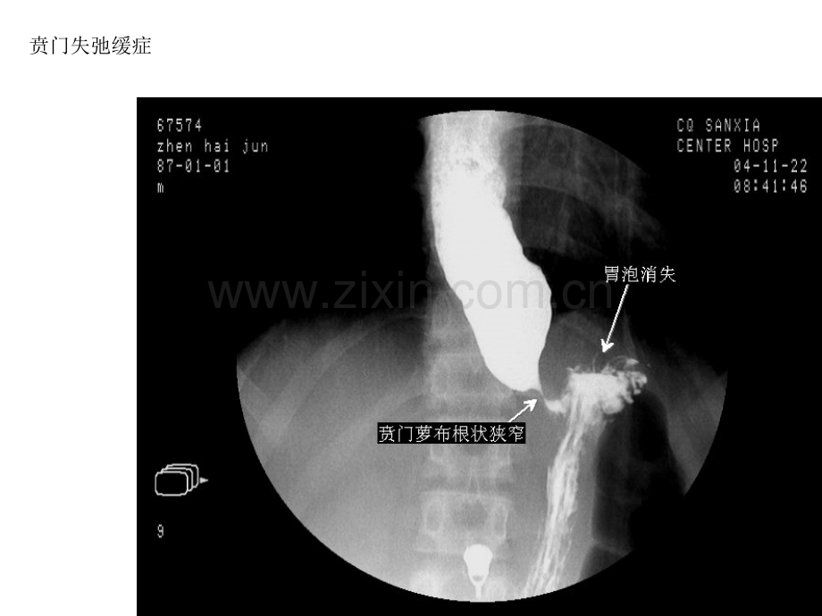 影像全套消化道钡餐图片.pptx_第3页