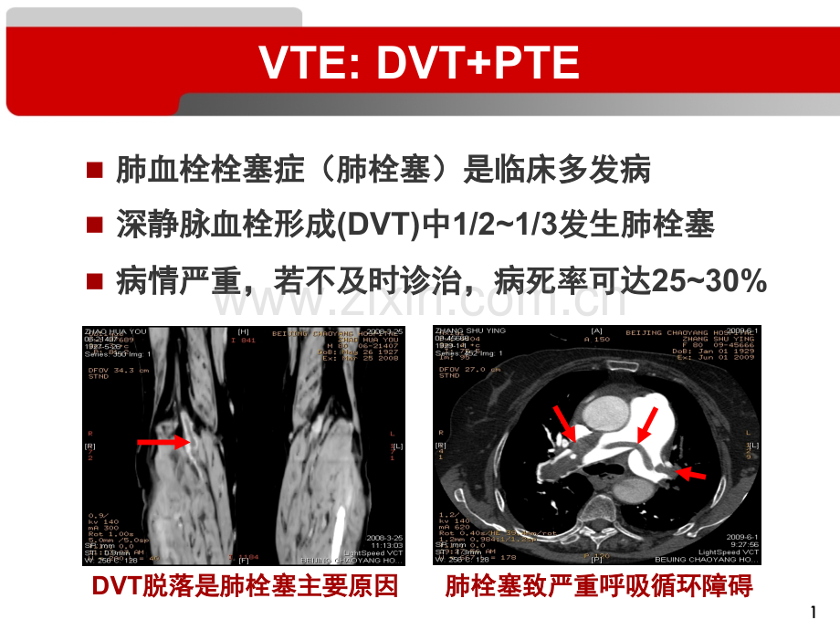 恶性肿瘤与静脉血栓栓塞症.pptx_第1页