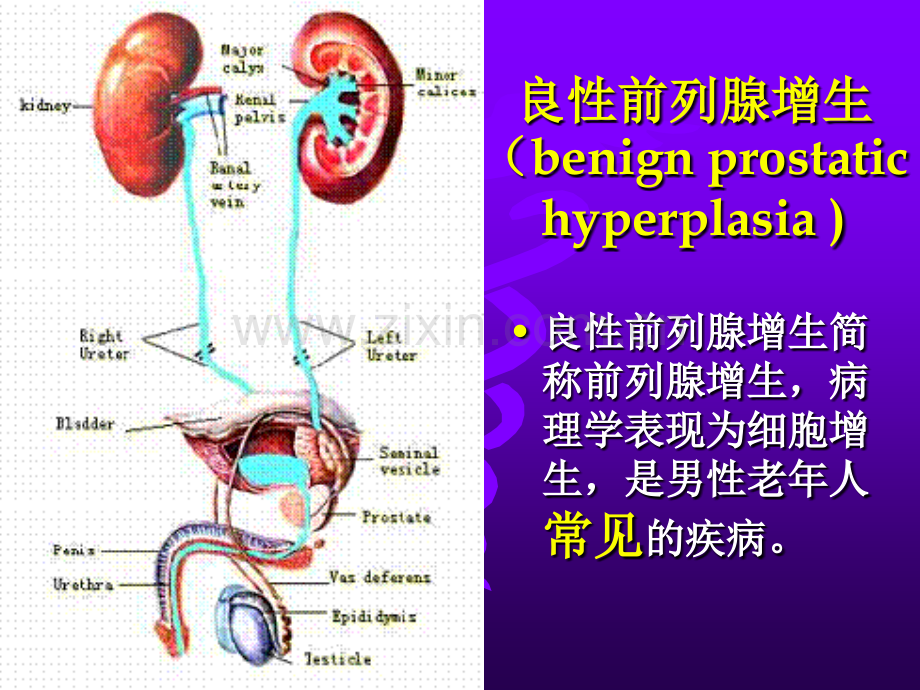 前列腺增生课件.pptx_第1页