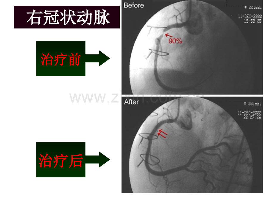 冠状动脉介入治疗的术前和术后护理.pptx_第3页