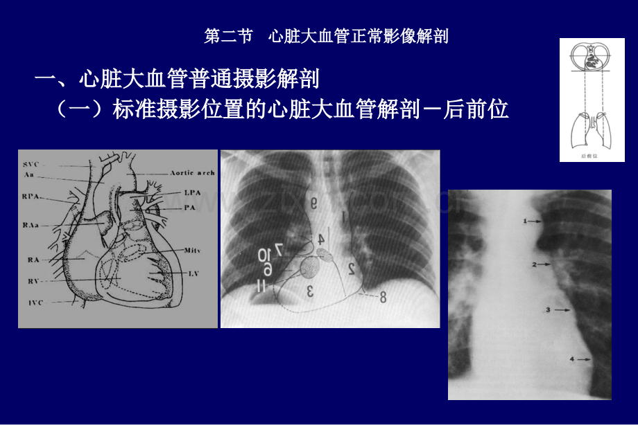 影像诊断学心脏和大血管.pptx_第3页