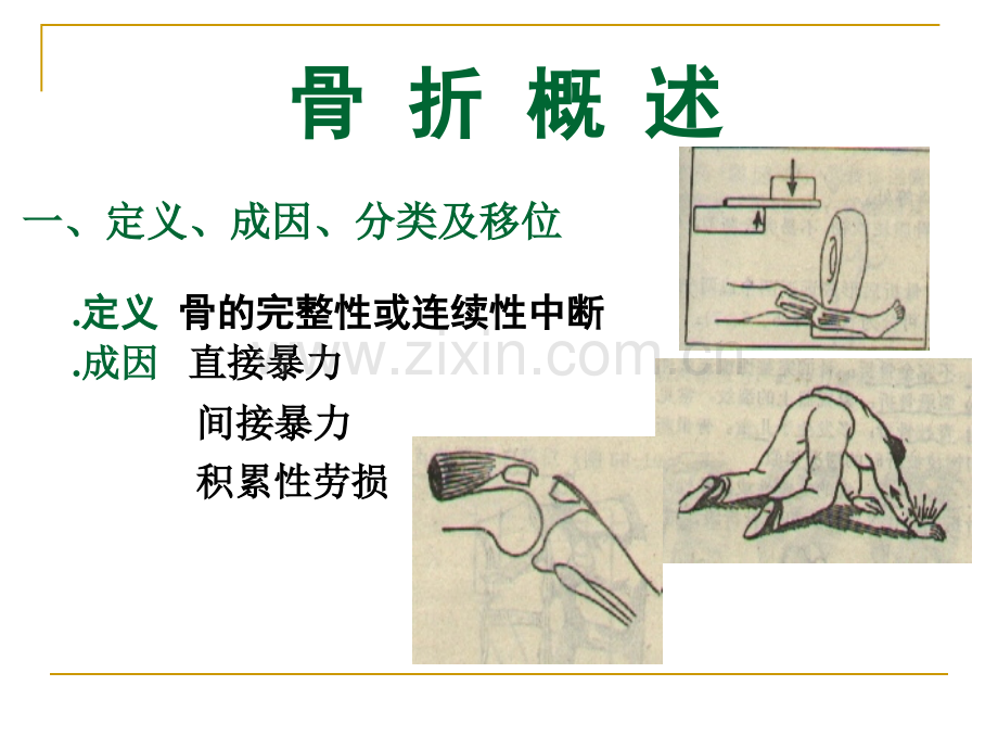 可出现前臂骨筋膜室综合征.pptx_第2页