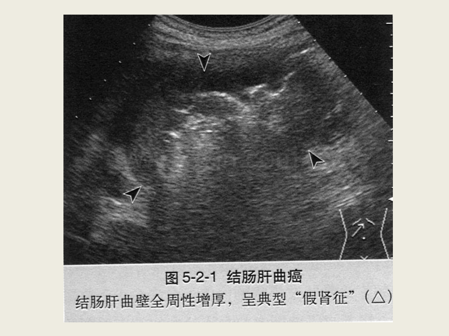 南昌大学超声课程之胃肠超声之四.pptx_第1页