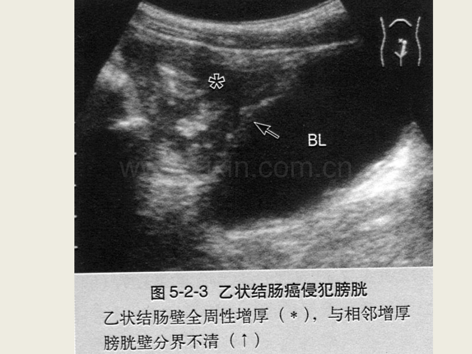 南昌大学超声课程之胃肠超声之四.pptx_第3页