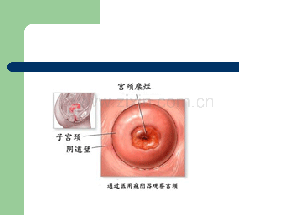 宫颈癌前病变.pptx_第3页