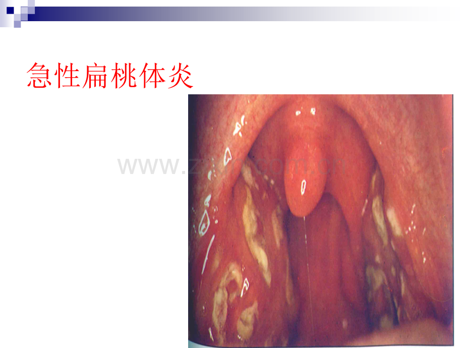 内科学扁桃体炎腺样体炎.pptx_第3页