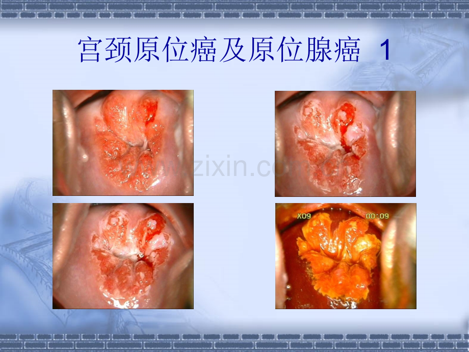 宫颈病例分享2012523.pptx_第2页