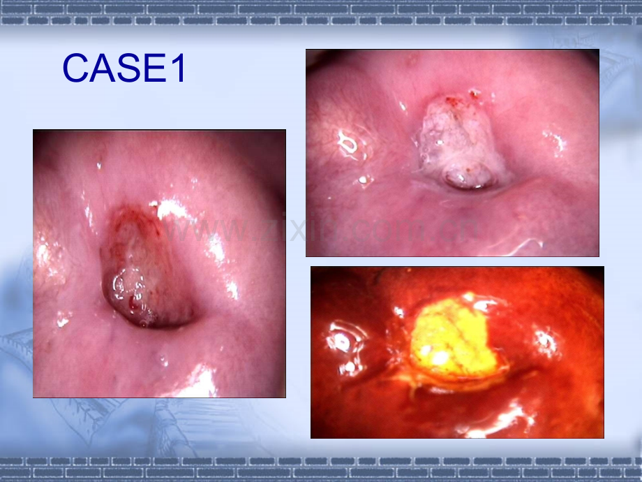 宫颈病例分享2012523.pptx_第3页