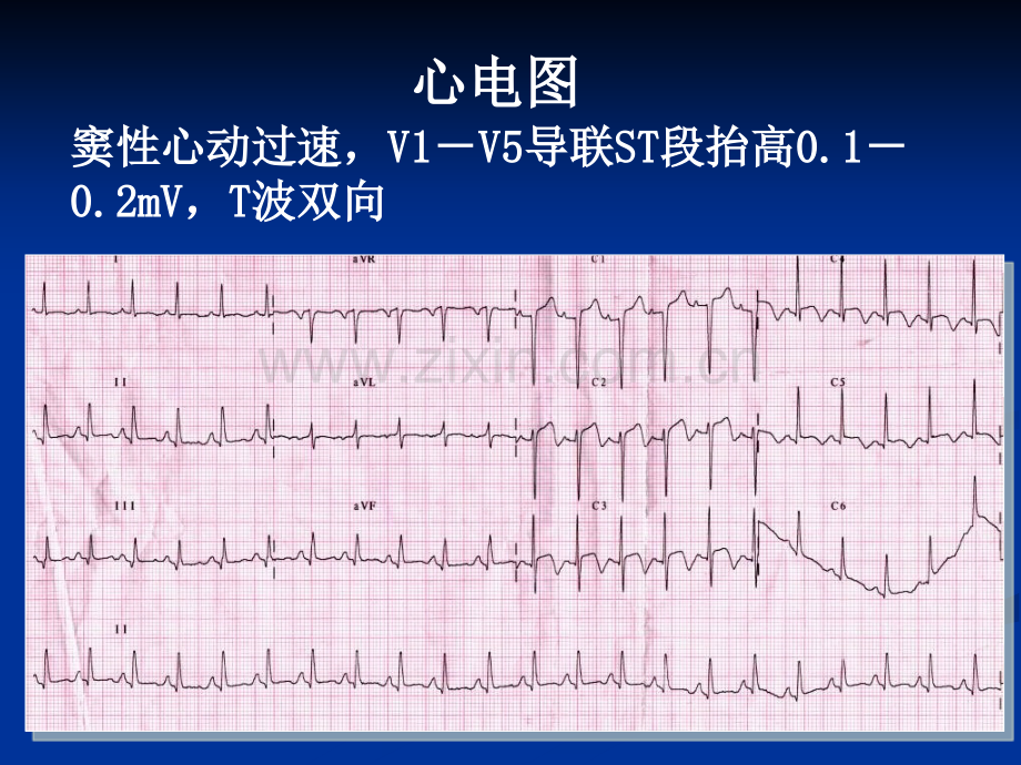 嗜铬细胞瘤北京安贞医院病例.pptx_第3页