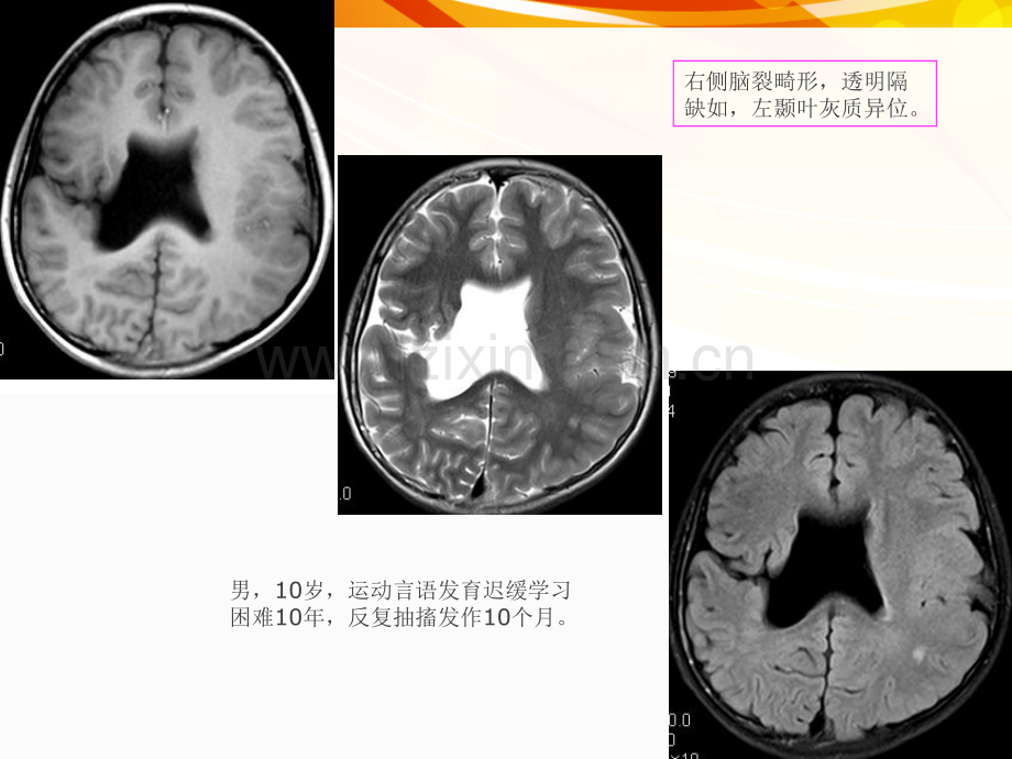 医学影像癫痫的MRI及.pptx_第2页