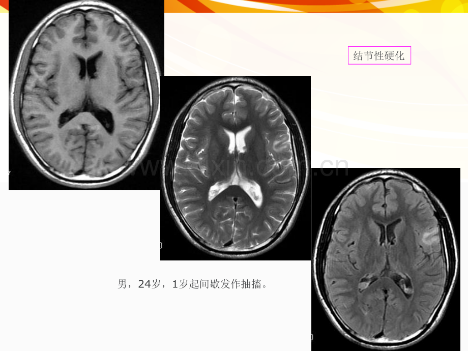 医学影像癫痫的MRI及.pptx_第3页