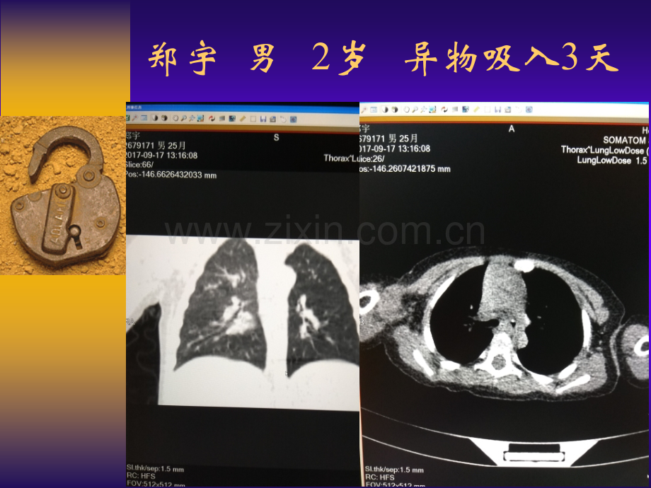 气管支气管异物的影像诊断1.pptx_第1页