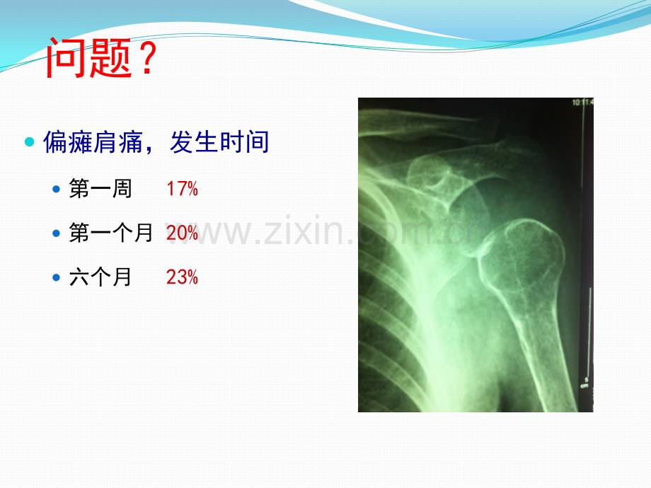 偏瘫后肩痛的治疗.pptx_第2页