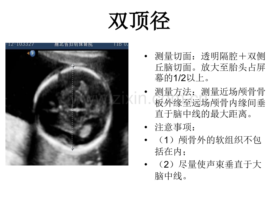 产科超声标准切面25张图.pptx_第1页