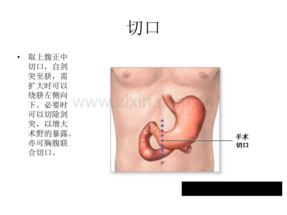 全胃切除术.pptx_第3页