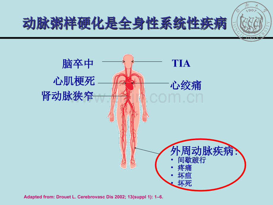 从循证医学证据看关注外周血管疾病的重要性.pptx_第3页