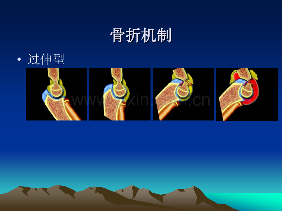 儿童肘关节骨折的X线诊断.pptx_第2页