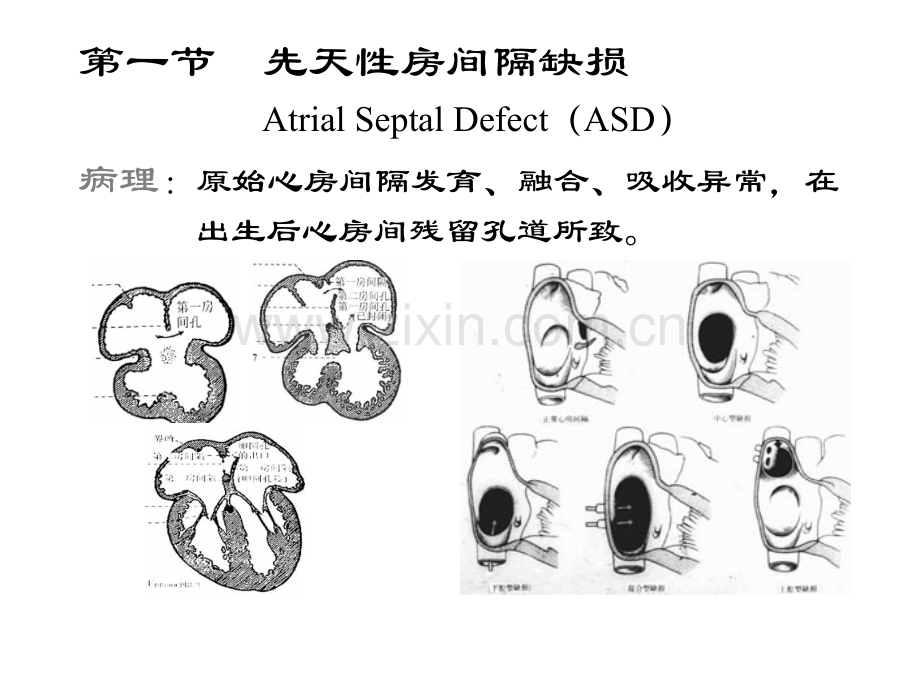 先天性心血管病精.pptx_第3页