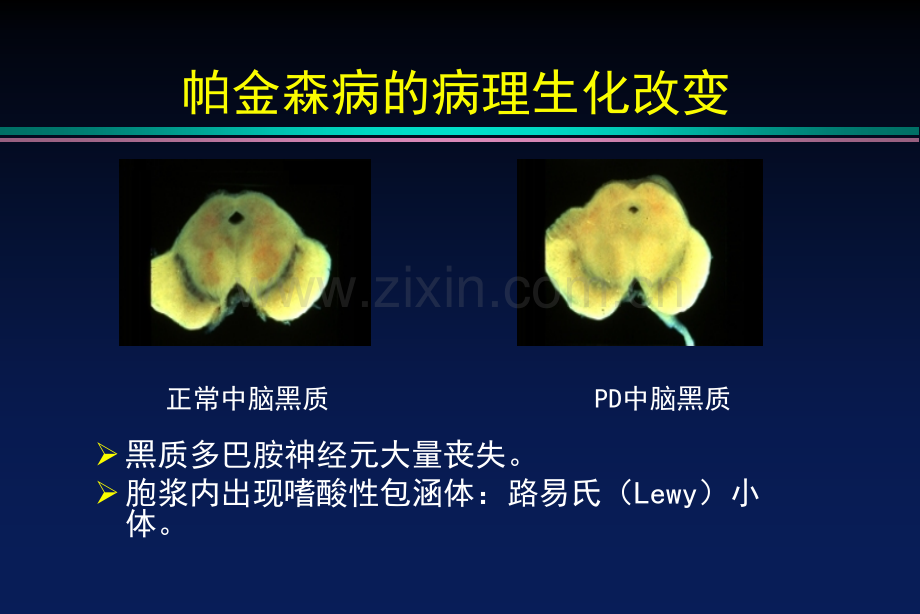 PD的诊断及治疗.pptx_第3页