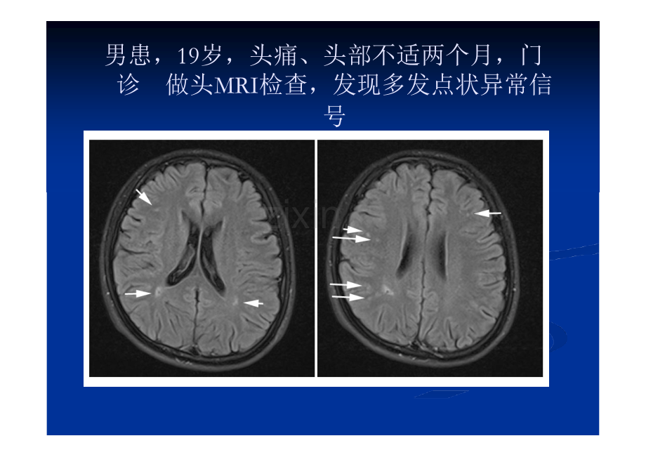 TCD发泡实验在神经内科疾病中应用的典型病例分析.pptx_第2页