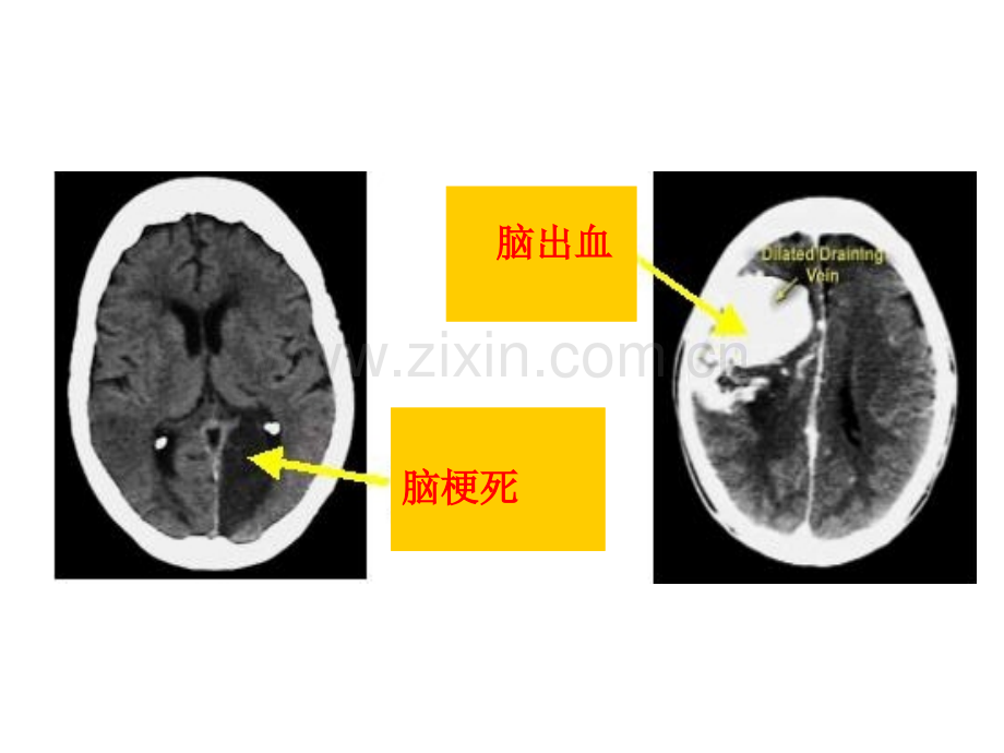 急性脑血管病.pptx_第3页