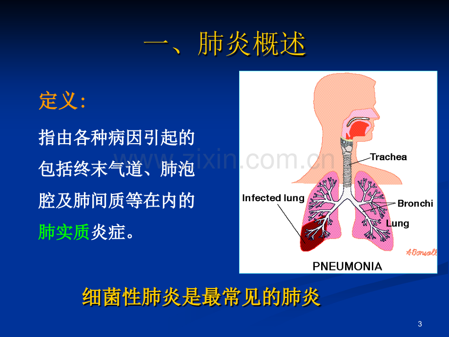 五肺炎球菌肺炎.pptx_第3页