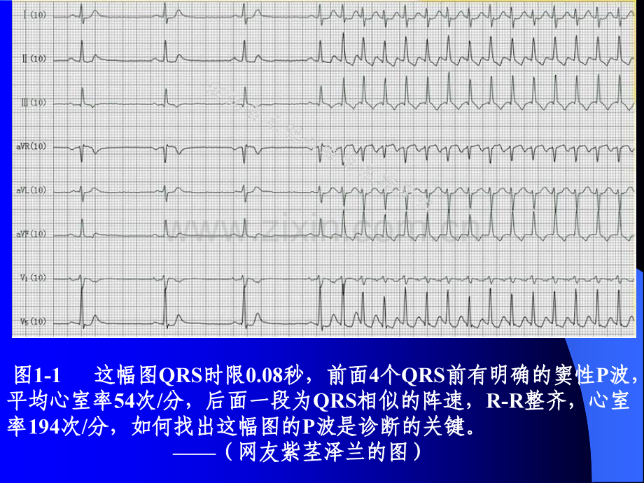 P波的识别与相关病例讨资料.pptx_第3页