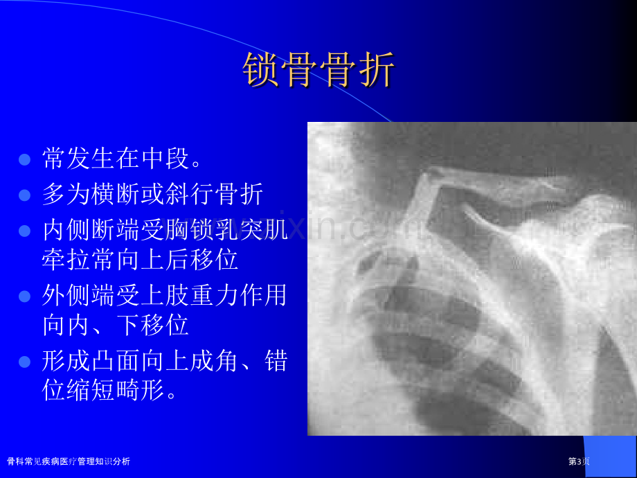 骨科常见疾病医疗管理知识分析.pptx_第3页