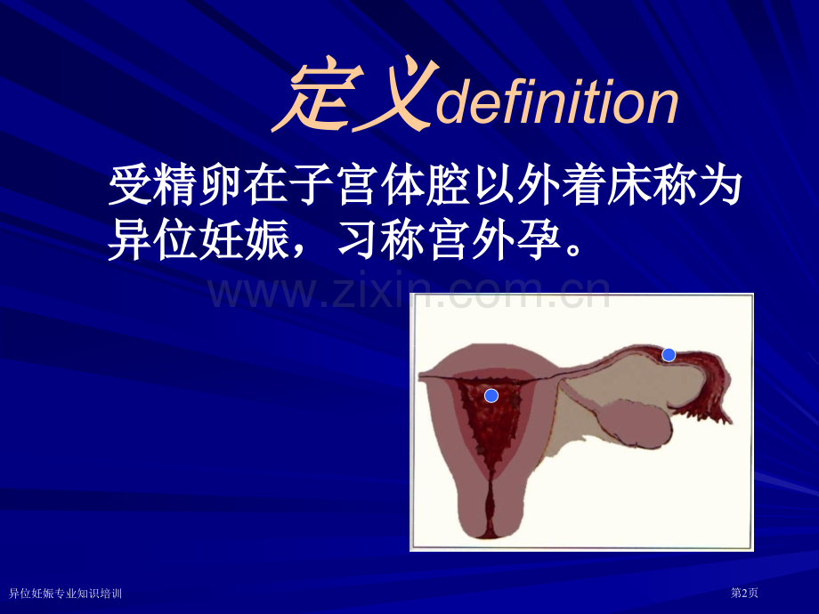 异位妊娠专业知识培训专家讲座.pptx_第2页