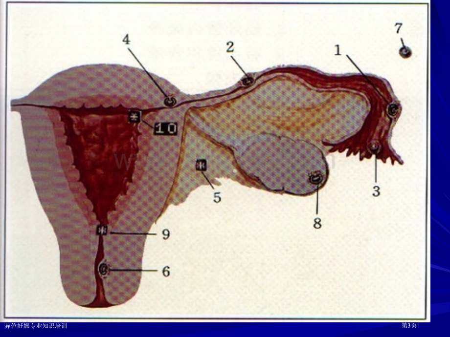 异位妊娠专业知识培训专家讲座.pptx_第3页