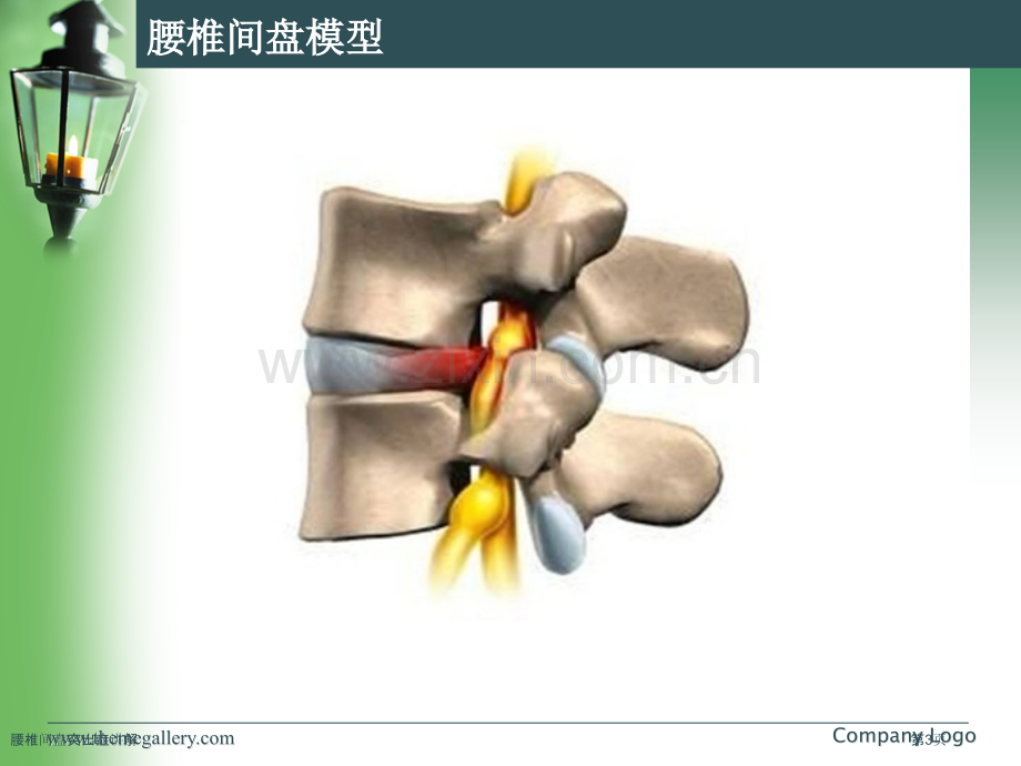 腰椎间盘突出症讲解专家讲座.pptx_第3页