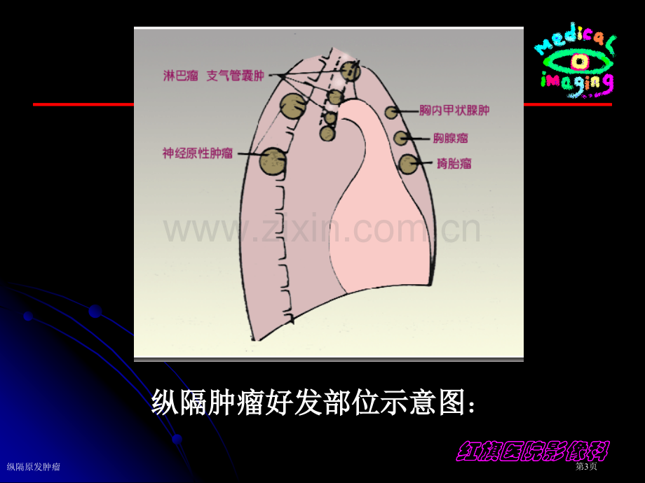 纵隔原发肿瘤专家讲座.pptx_第3页