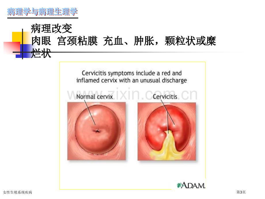 女性生殖系统疾病专家讲座.pptx_第3页