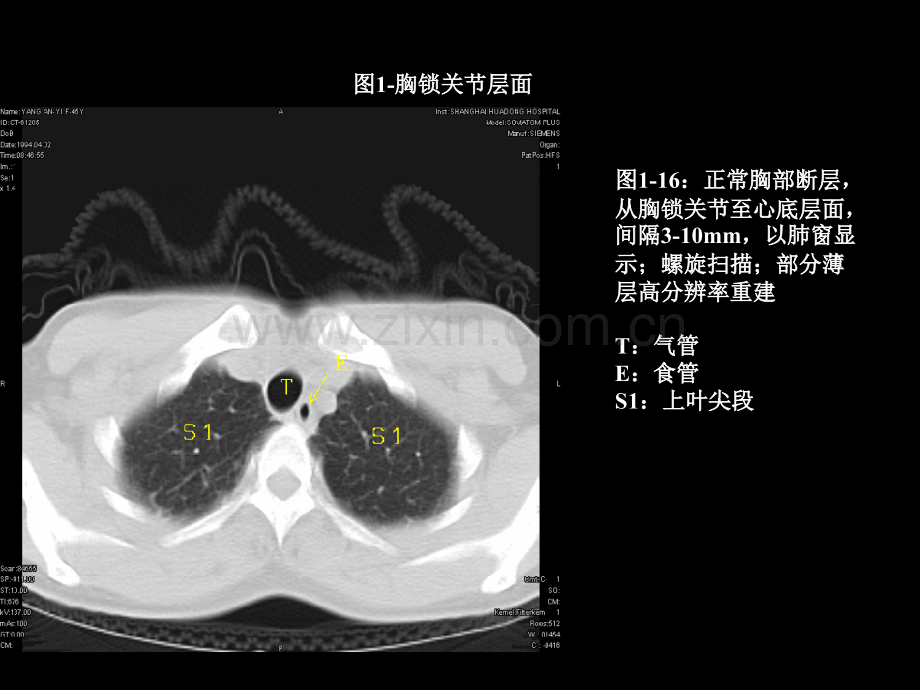 胸部肺段划分CT专家讲座.pptx_第1页