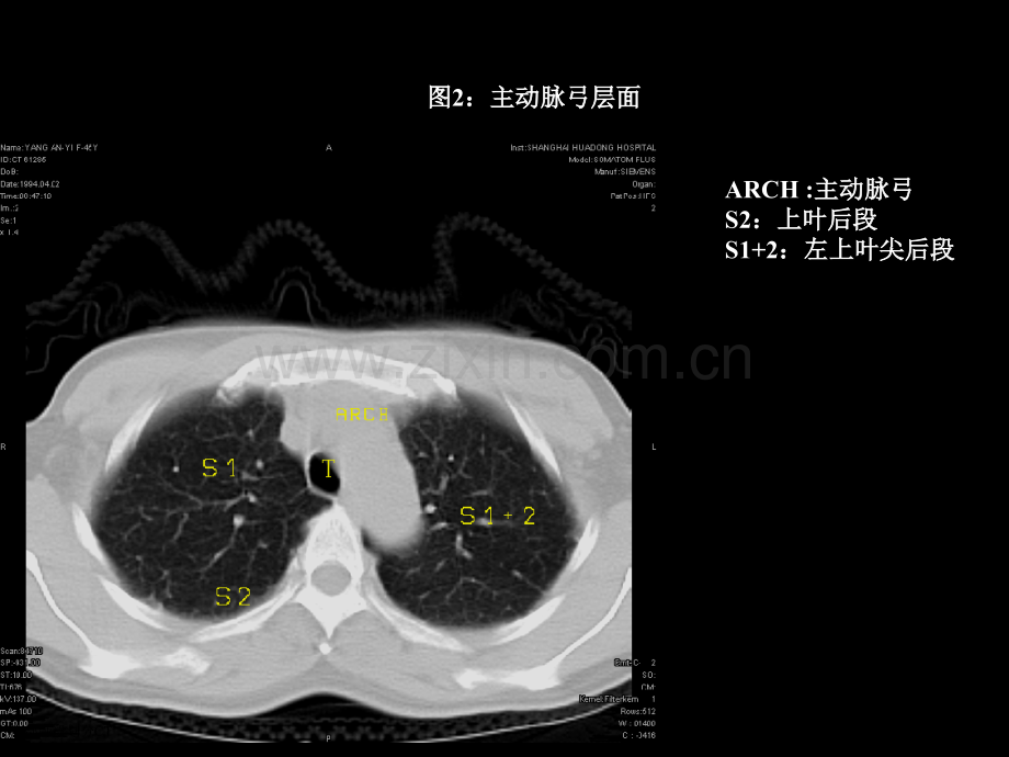 胸部肺段划分CT专家讲座.pptx_第2页