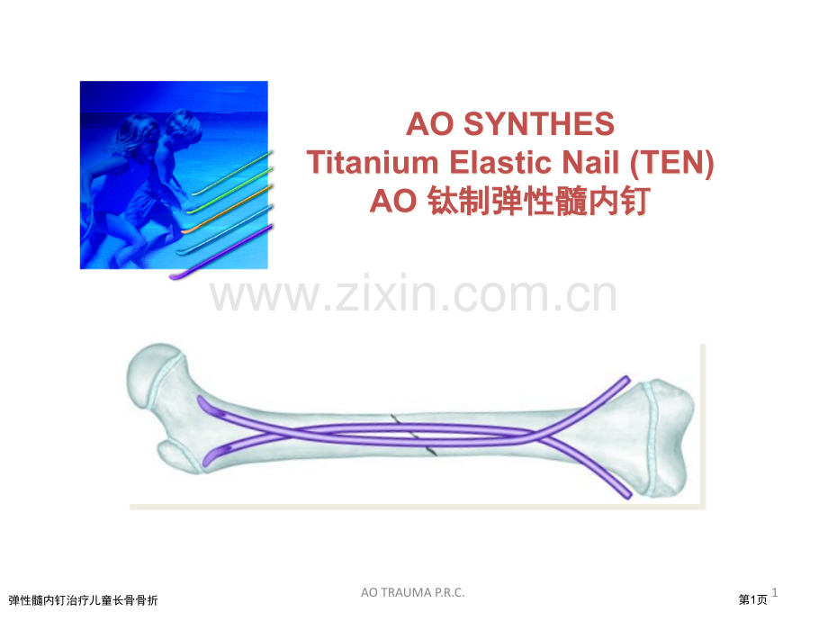 弹性髓内钉治疗儿童长骨骨折.pptx_第1页